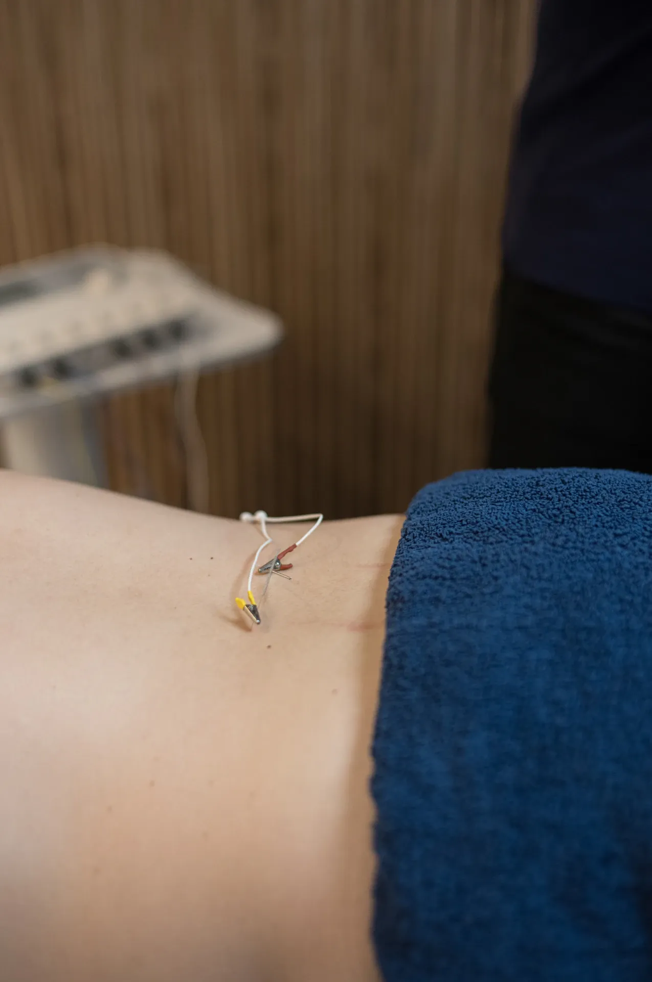 Primer plano de punción seca en la zona lumbar, en la clínica de Iñigo Goikoetxea, fisioterapeuta en Bilbao